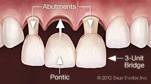 Dental Bridges