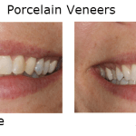 Porcelain Veneers