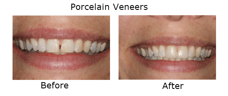 Porcelain Veneers
