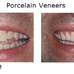 Porcelain Veneers