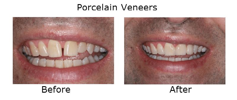 Porcelain Veneers
