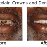 Porcelain Crowns and Denture
