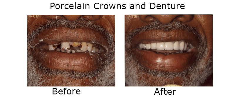 Porcelain Crowns and Denture