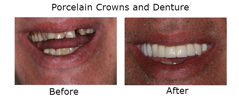 Porcelain Crowns And Denture