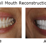 Full Mouth  Reconstructions