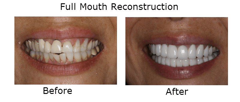 Full Mouth  Reconstructions