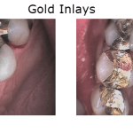 Gold Inlays