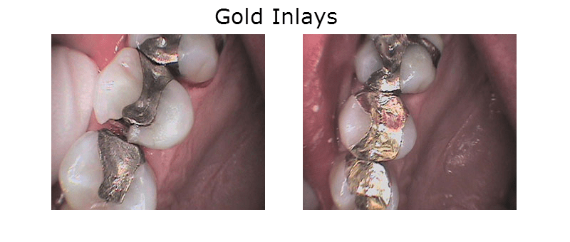 Gold Inlays