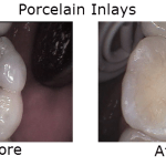 Porcelain Inlays
