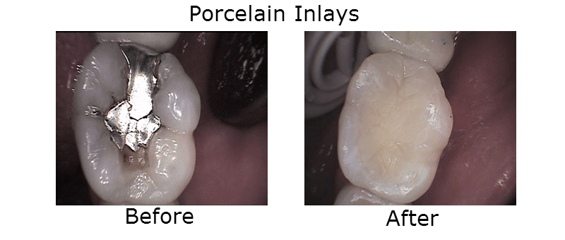 Porcelain Inlays