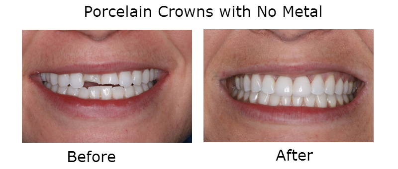 Porcelain Crowns with no metal before and after
