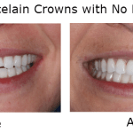 Porcelain Crowns with no metal before and after