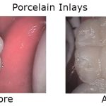 Porcelain Inlays