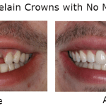 Porcelain Crowns with no metal before and after