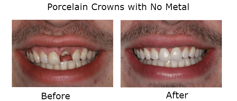 Porcelain Crowns with no metal before and after
