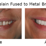 Porcelain Crowns fused to metal bridge