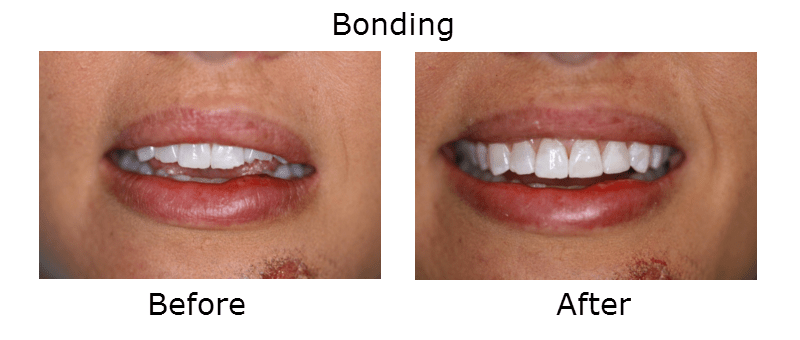 Dental Bonding 