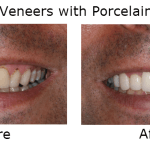 Porcelain Veneers with Porcelain Crowns