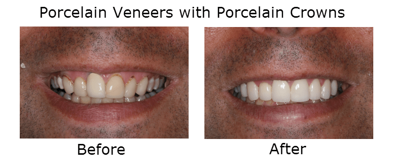 Porcelain Veneers with Porcelain Crowns