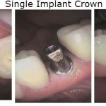 Single Implant Crowns