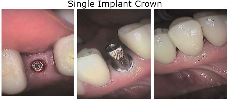 Single Implant Crowns