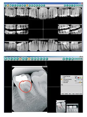 Digital X- Rays