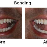 Dental Bonding