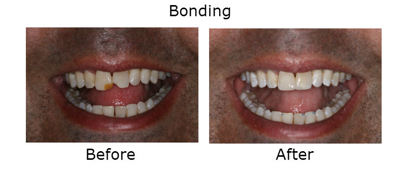 Dental Bonding