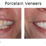 Porcelain Veneers