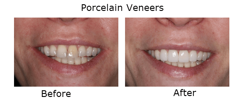 Porcelain Veneers