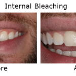 Internal Bleeching