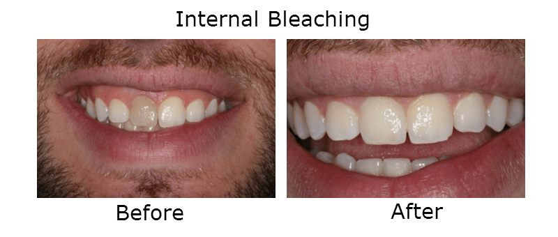 Internal Bleeching