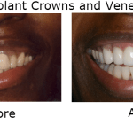 Implant Crowns and Veneers
