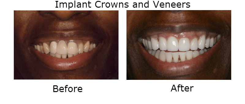 Implant Crowns and Veneers