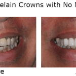 Porcelain Crowns with no metal before and after