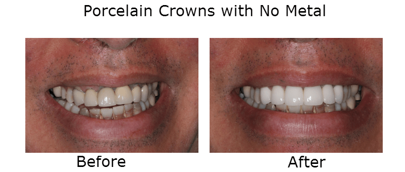 Porcelain Crowns with no metal before and after