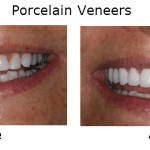 Porcelain Veneers
