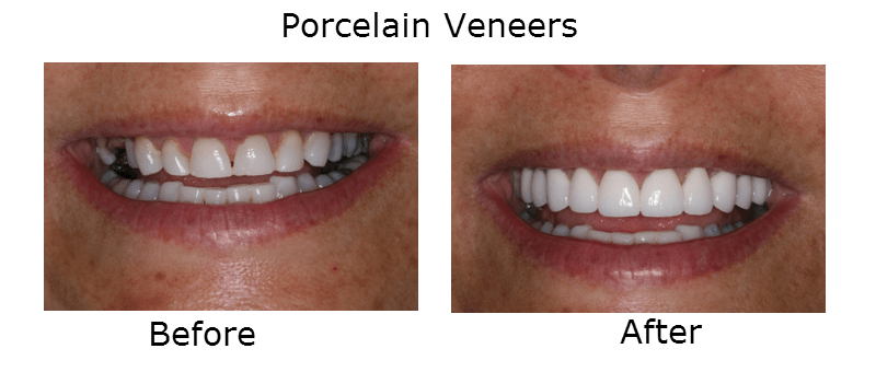 Porcelain Veneers